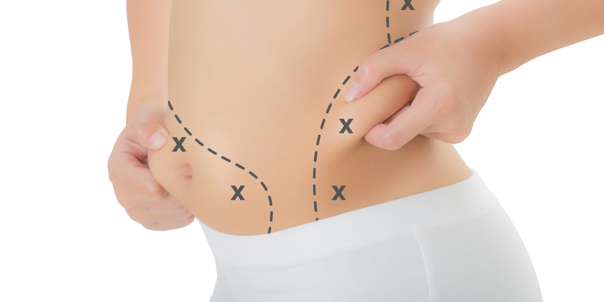 Non-Surgical Fat Reduction Techniques: Efficacy and Safety